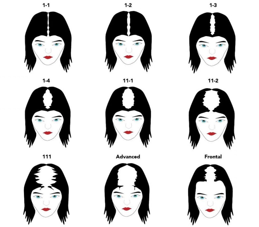 Diagram showing progressive stages of female pattern hair loss from mild thinning to advanced baldness.