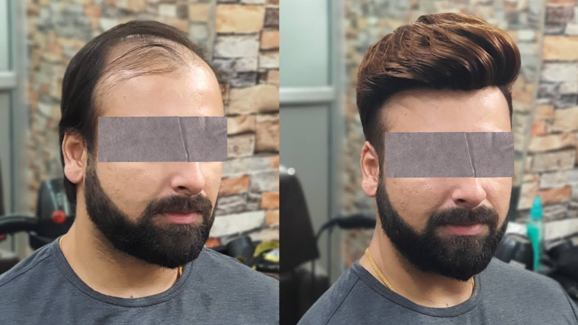 Before and after results of hair patch treatment showing natural hair restoration in men.