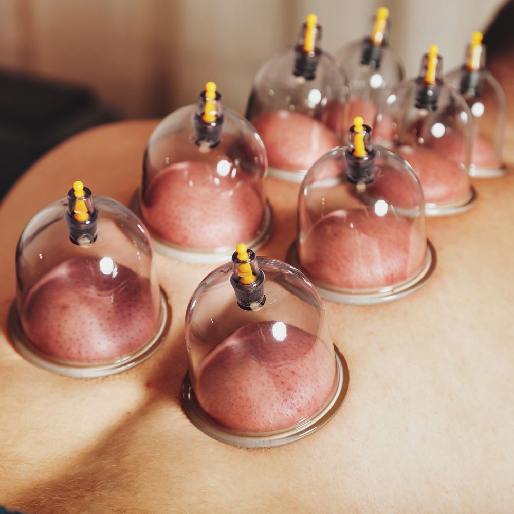 Cupping therapy for muscle pain relief at Aquaporin Aesthetic Hair-Skin Clinix & Labs