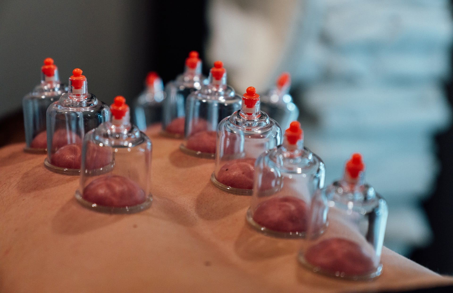 Cupping therapy session with suction cups applied to the back for pain relief and improved circulation