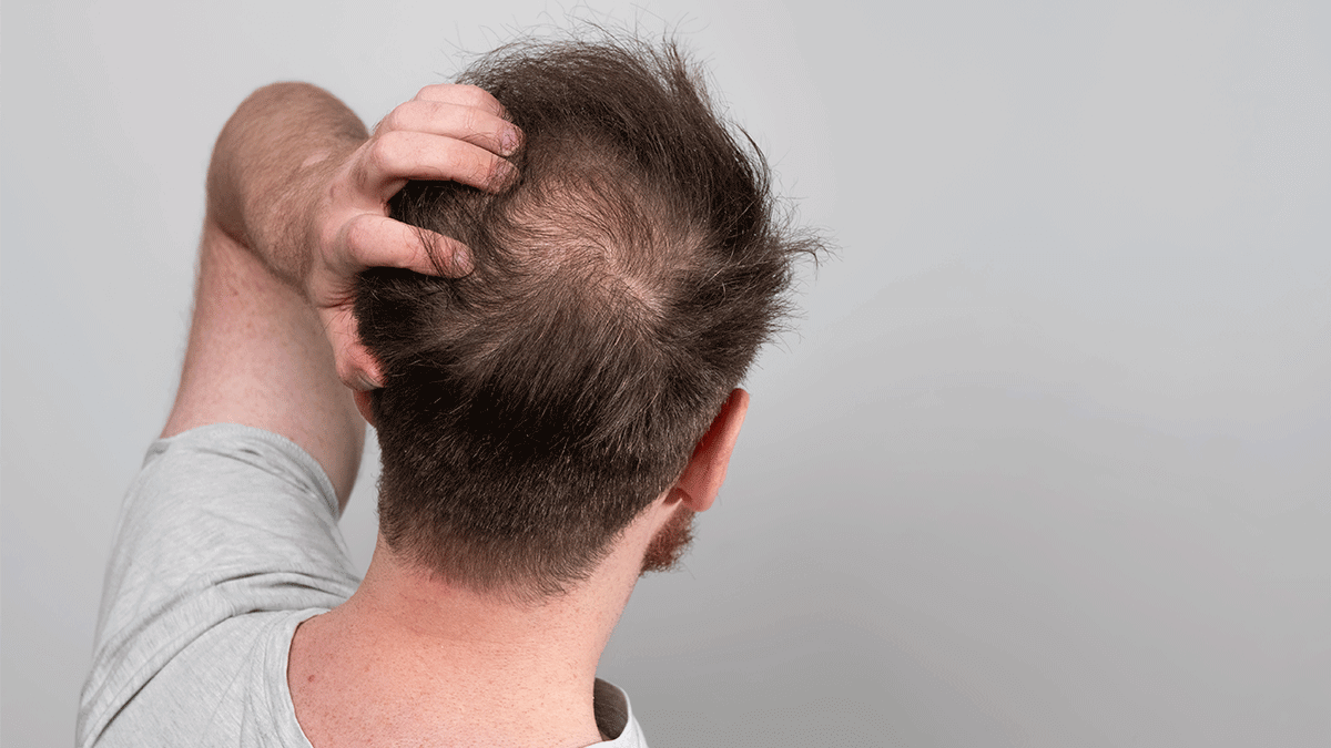 Man showing hair thinning and bald spots on the scalp, indicating hair loss condition