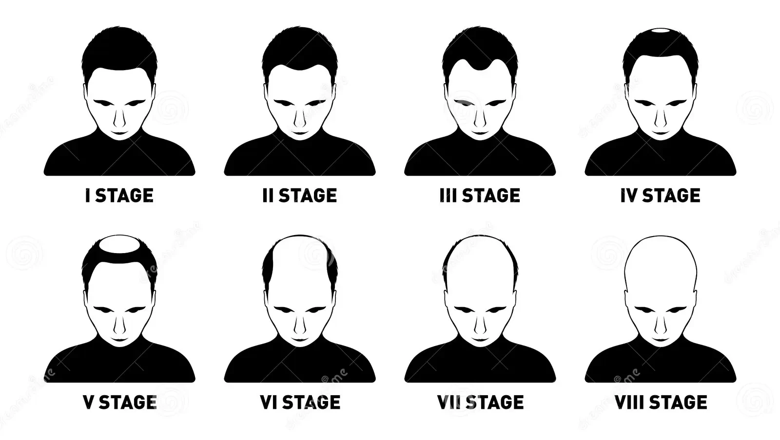 Stages of male pattern baldness diagram showing progressive hair loss from stage I to stage VIII.