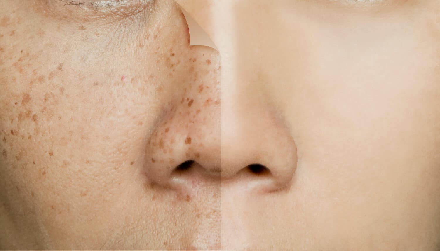 Before and after pigmentation treatment at Aquaporin Aesthetic Hair-Skin Clinix & Labs