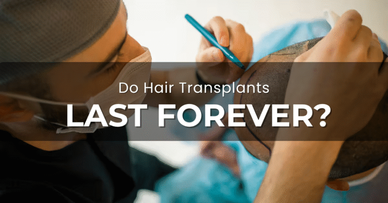 Surgeon marking a patient’s scalp before performing a hair transplant procedure.