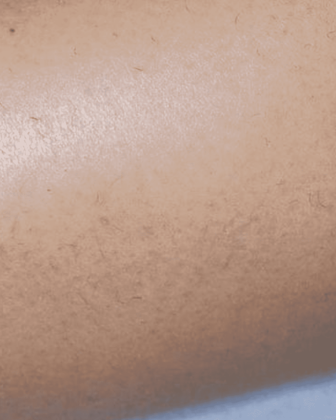 Laser hair removal after image showing smooth hair-free skin