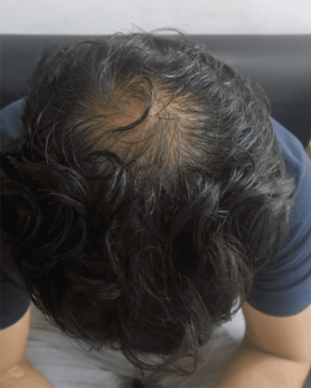 Hair loss treatment before showing thinning hair and scalp visibility