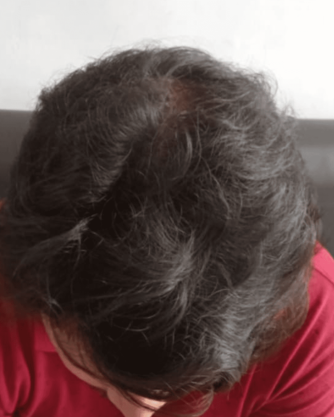 Hair loss treatment after image showing thicker and denser hair