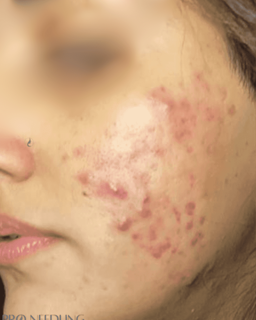 Scar treatment before image showing deep facial scars