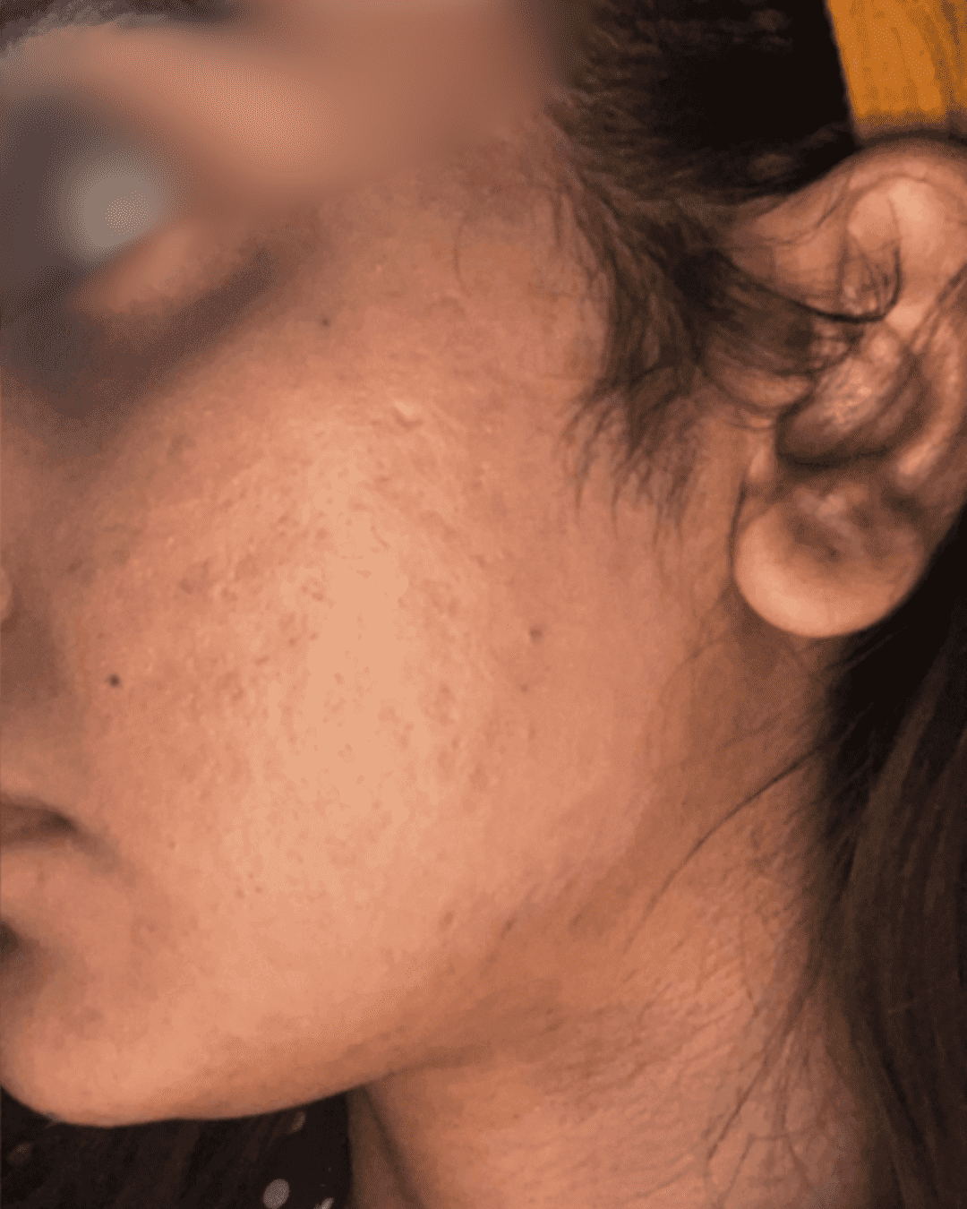 Scar treatment after image showing smoother scar-free skin