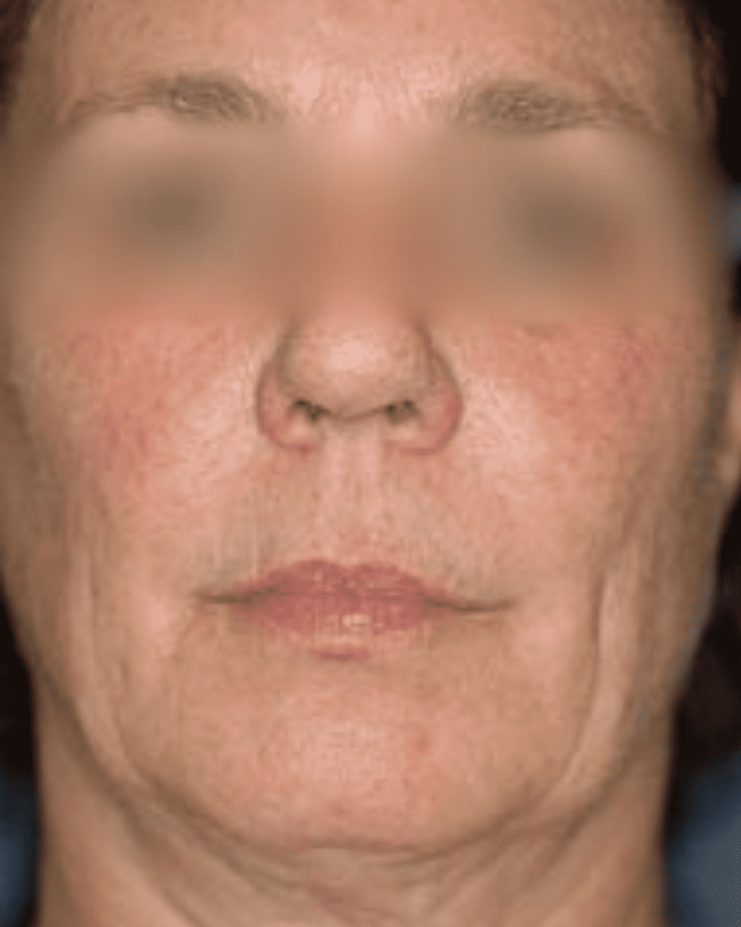 Anti-aging treatment before image showing fine lines and wrinkles