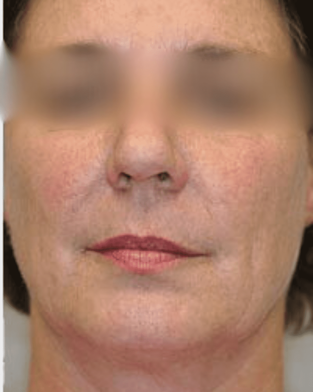 Anti-aging treatment after image showing youthful glowing skin