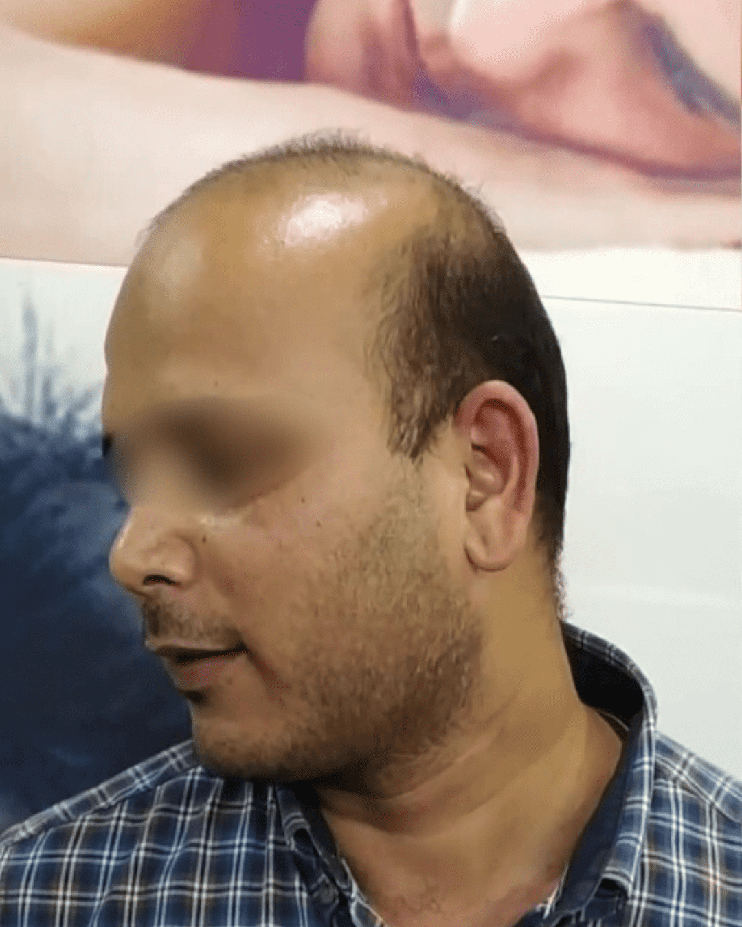 Hair patch treatment before image showing partial baldness