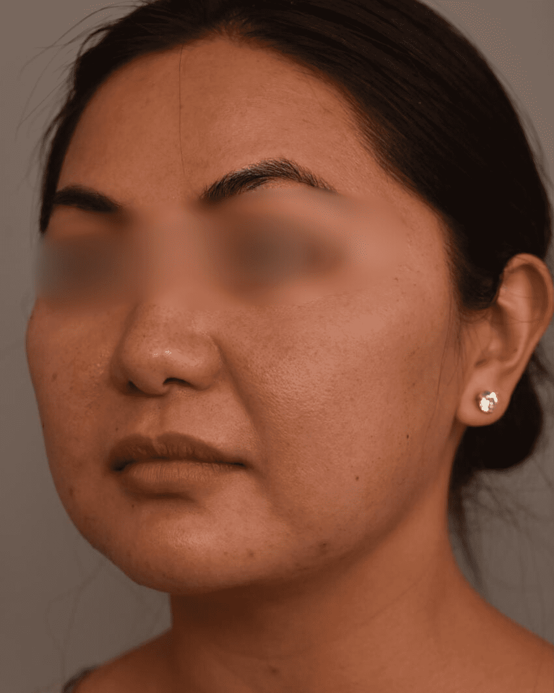 Fat reduction before image showing stubborn fat on abdomen