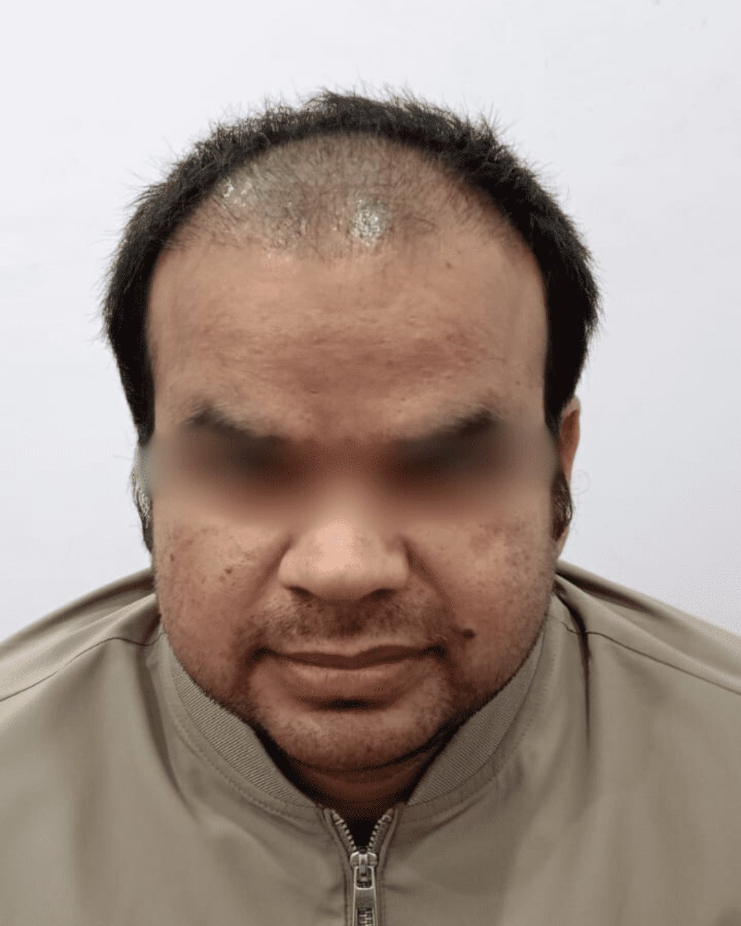 Hair transplant before showing bald scalp with receding hairline