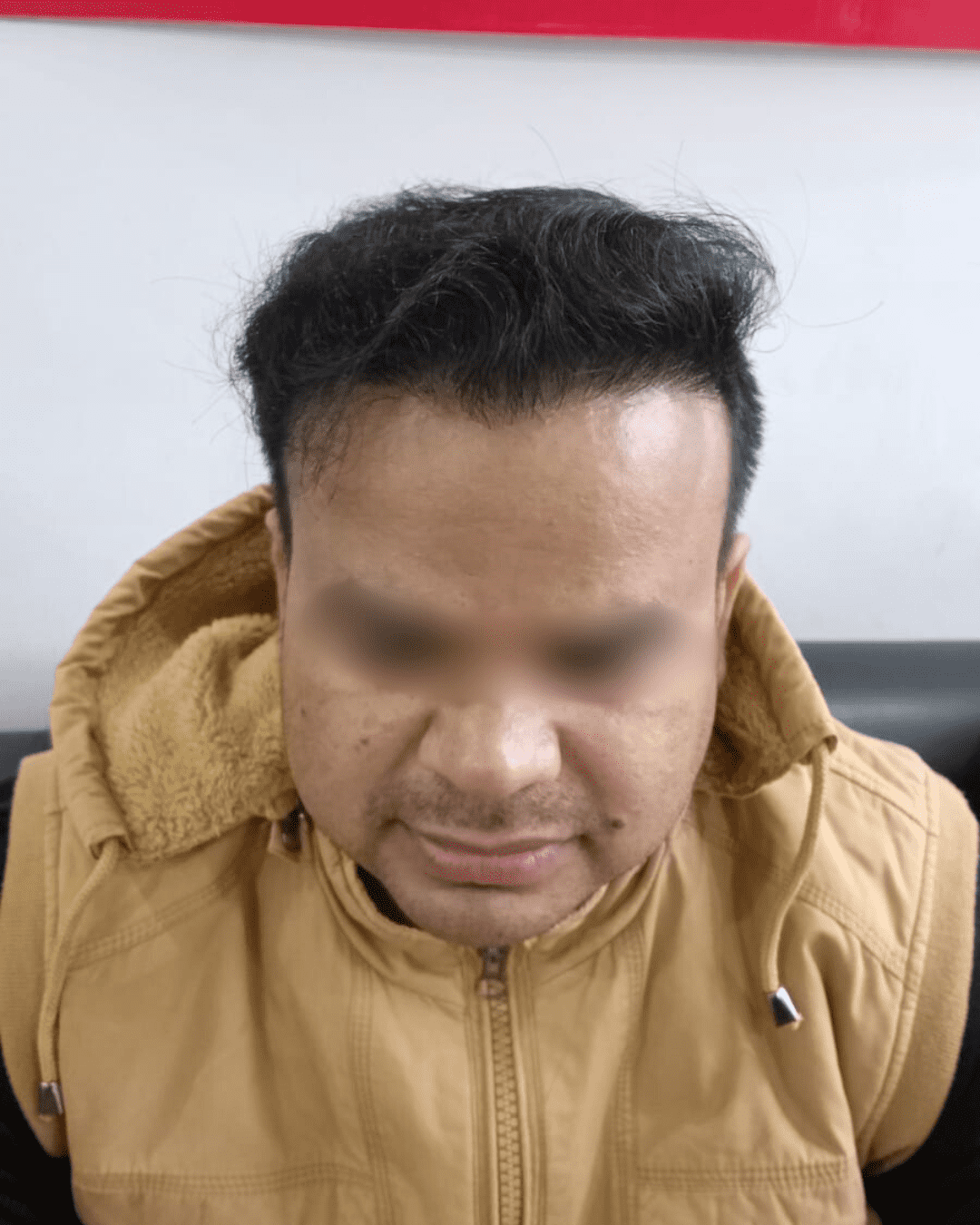 Hair transplant after image showing natural hair growth and restored hairline
