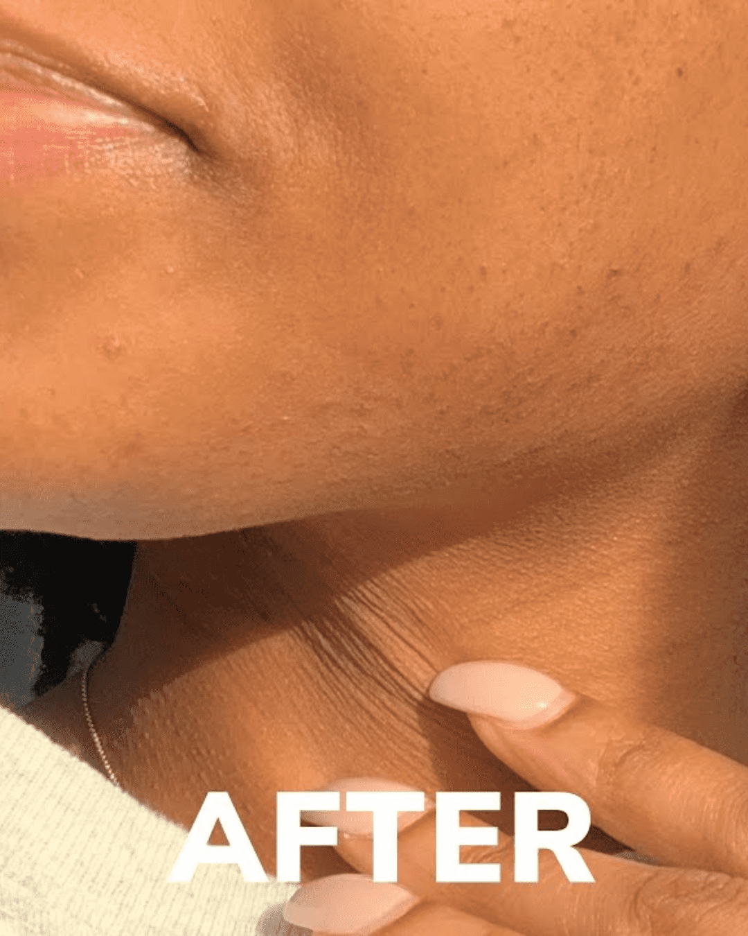 Pigmentation treatment after image showing clear and even skin tone