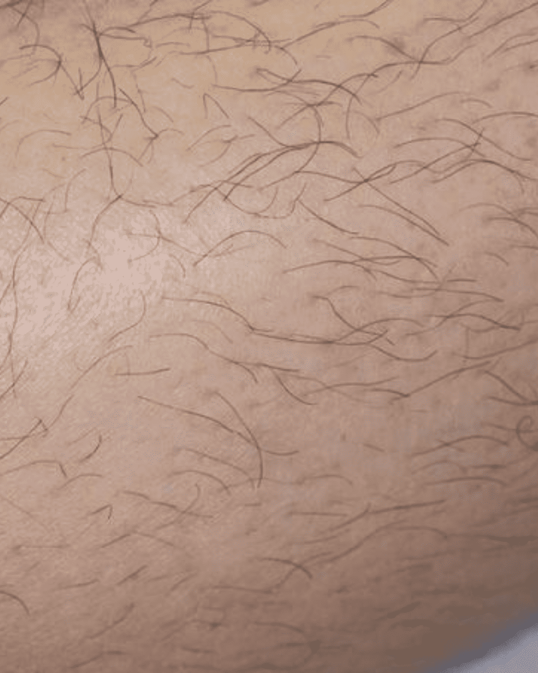 Laser hair removal before image showing unwanted hair on skin