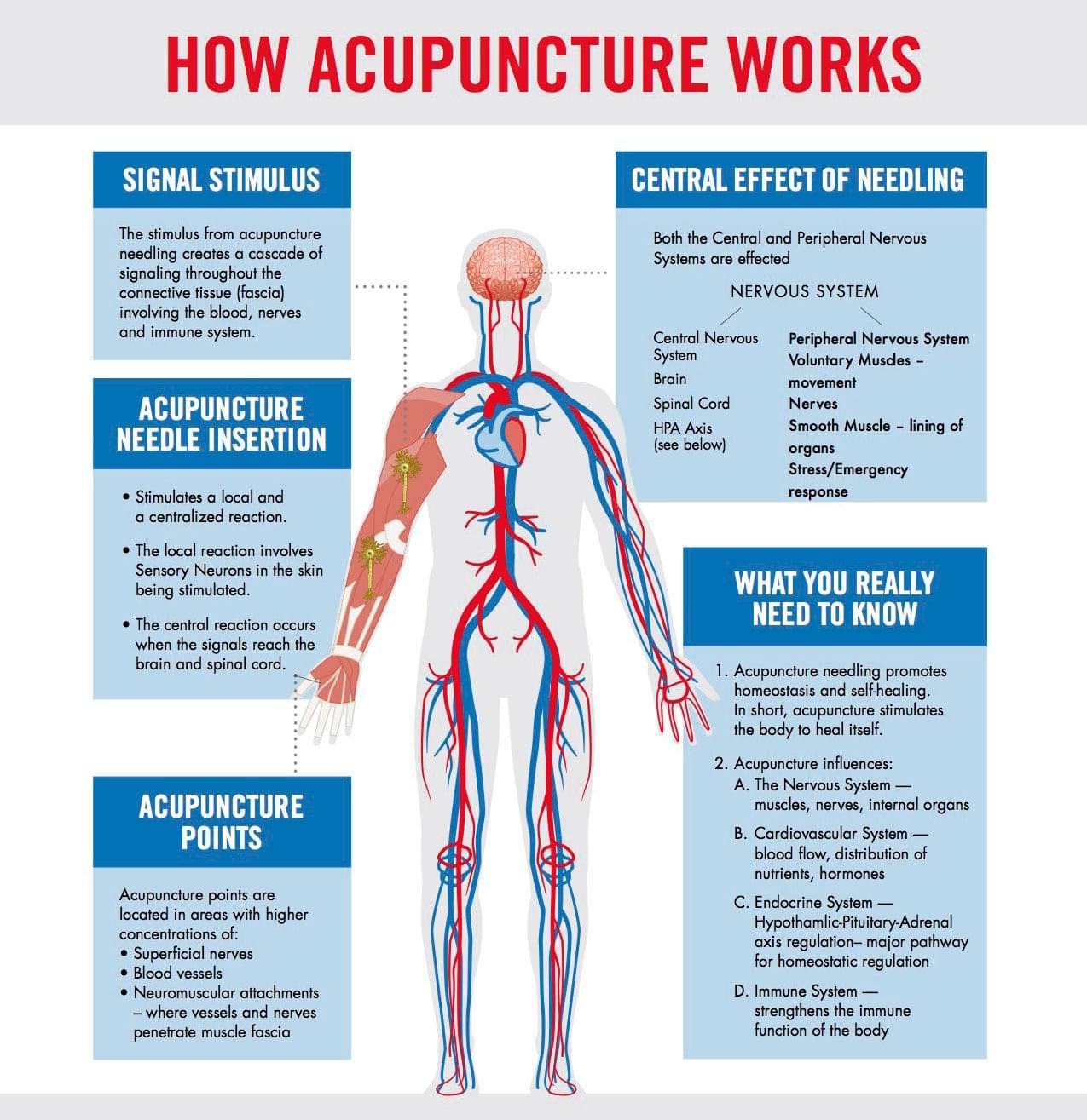 How acupuncture works infographic showing needle points, nerve system effects, and healing benefits