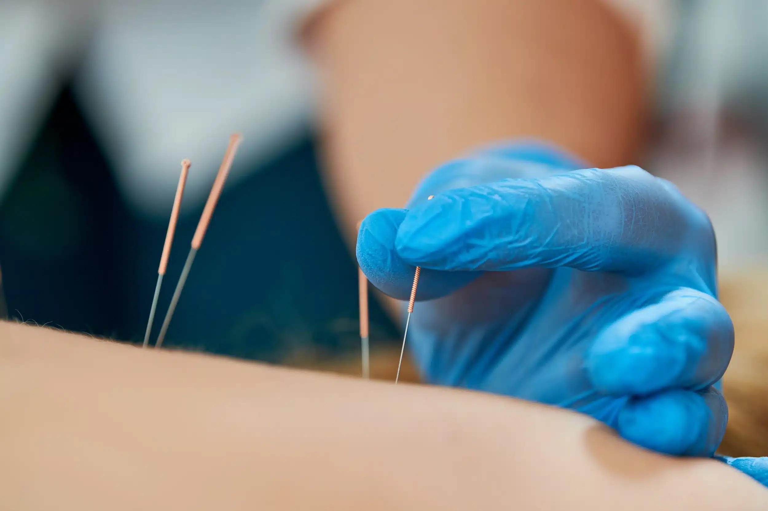 Practitioner inserting acupuncture needles into skin for pain relief therapy